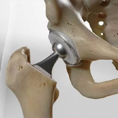 جراحی تعویض مفصل زانو و هیپ توسط دکتر جمشید ایمانی