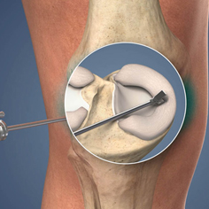 آرتروسکوپی زانو جهت درمان پارگی رباط صلیبی و منیسک