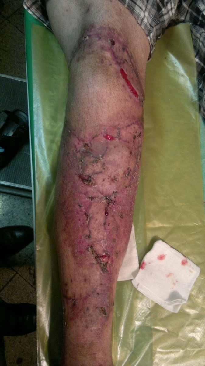 یک نمونه درمان بیمار 50 ساله تصادفی با شکستگی باز و شدید ساق پا که در بیمارستان آسیا توسط اینجانب درمان در چندمرحله انجام گرفت